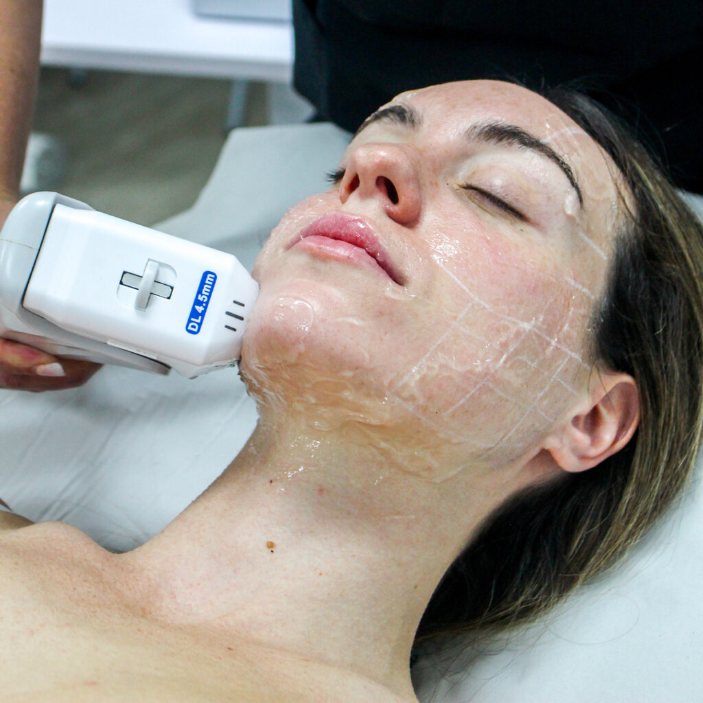 Explotación compartida HIFU de Adermica en Valencia. Un tratamiento facial rejuvenecedor.